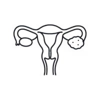 Ovarian Cyst